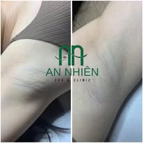TRIỆT NÁCH  • 250K / 1 buổi • 1.800K / 10 buổi • 2.800K / Bảo hành 5 năm